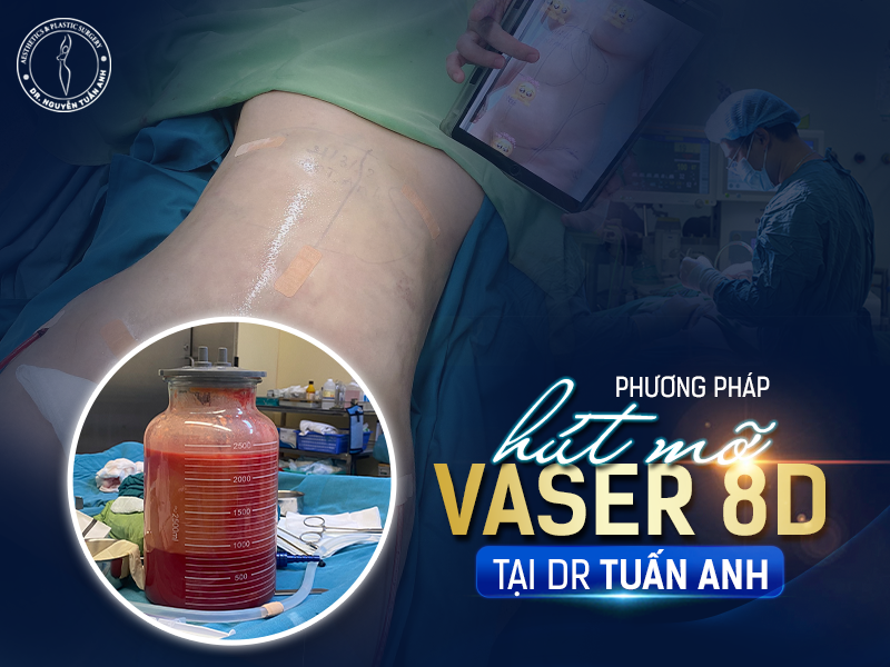 Phuong phap hut mo Vaser 8D tai Dr Tuan Anh
